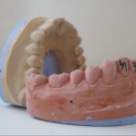 dental mold